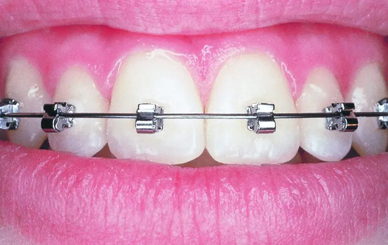 Close-up of a person's mouth showcasing teeth with Speed Braces and pink gums in Greenville, SC