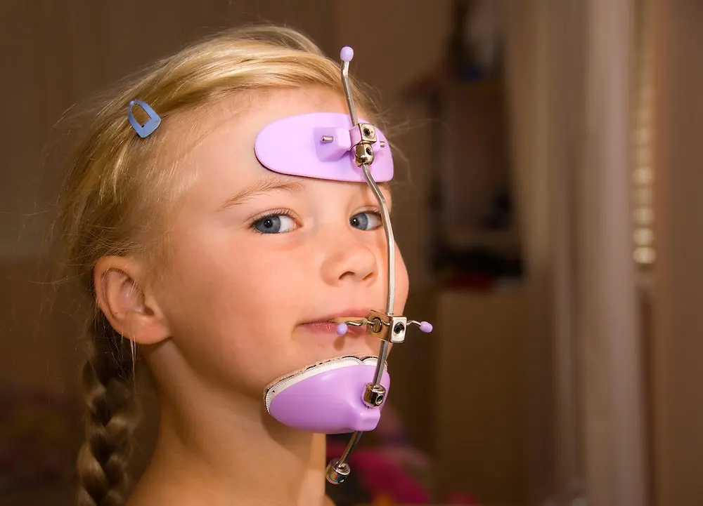 Young girl wearing lilac pull reverse headgear with braces in Greenville, SC, focusing on orthodontic treatment.