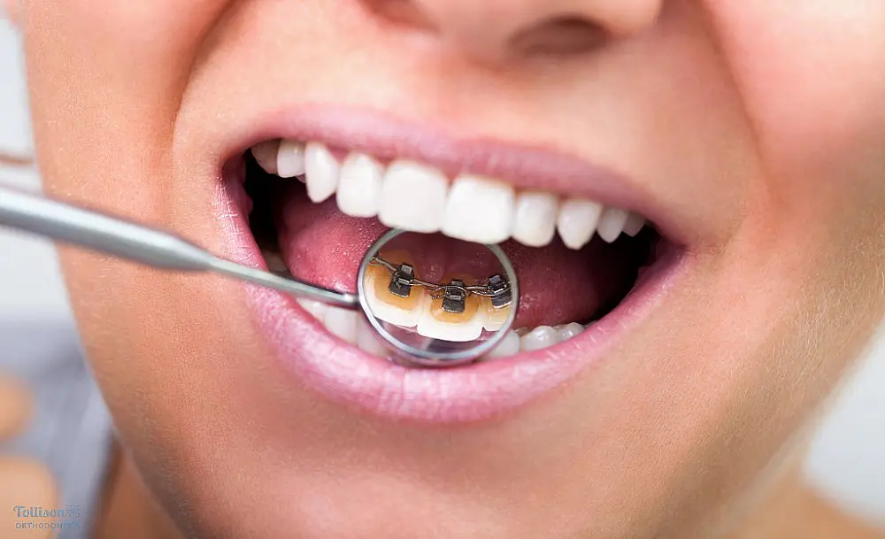 Close-up of a dental mirror showing lingual braces as one option of alternatives to braces in Greenville, SC attached to the back of a patient’s teeth.