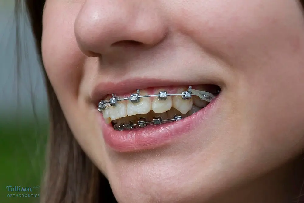 Close-up of a smiling patient showing metal braces on teeth – braces for overbite in Greenville, SC.
