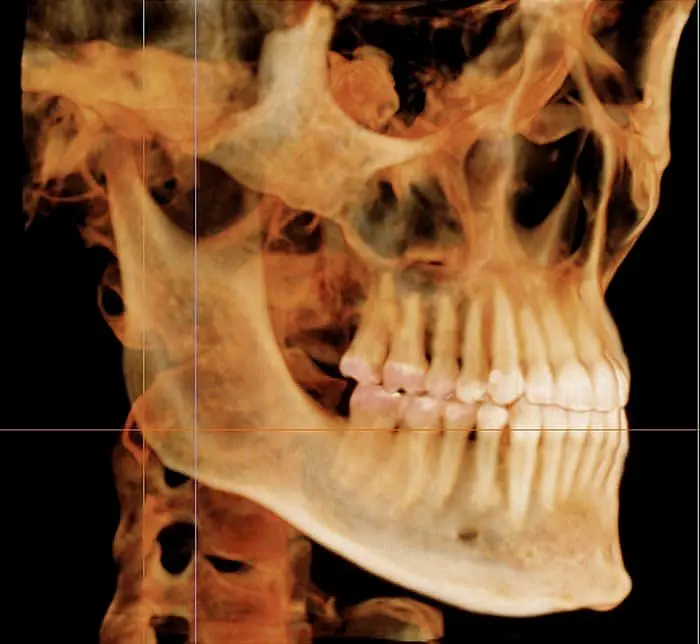 A 3D-rendered skull scan highlights teeth and jawbone, perfect for Tollison Orthodontics consultations in Greenville, SC.