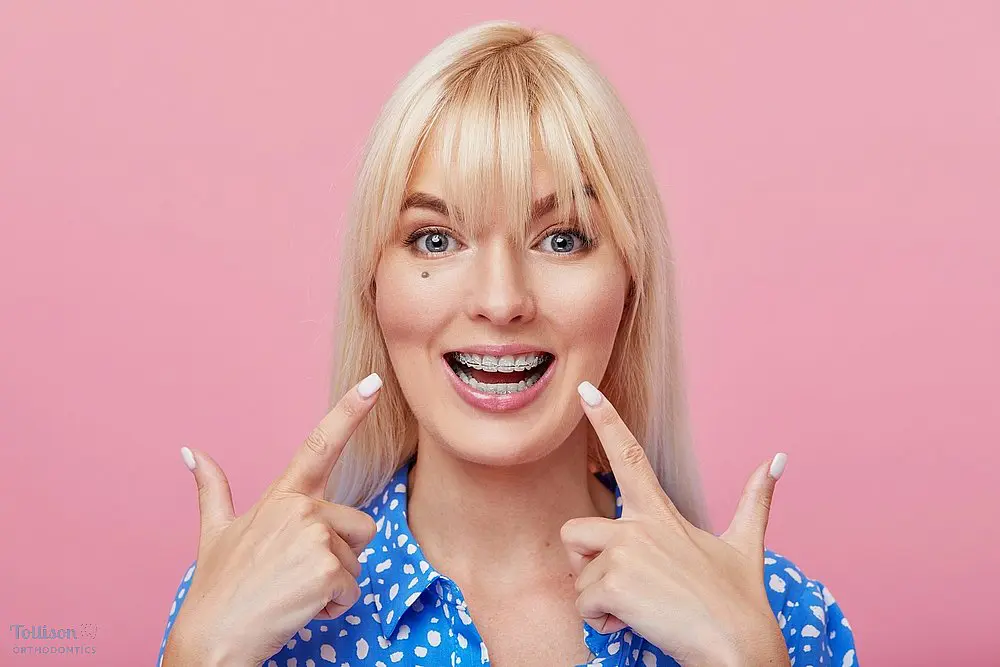 cheerful happy young woman blonde hair gesturing thumb while pointing clear braces - Clear Braces vs Metal Braces in Greenville, SC