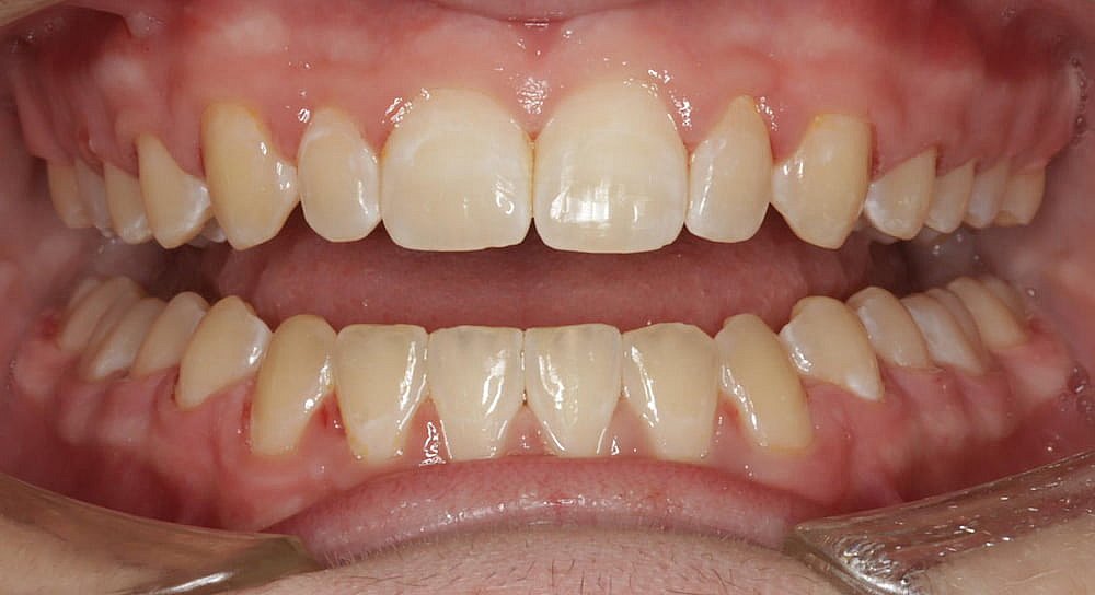 Close-up of a person's mouth showing upper and lower teeth with the lips held apart, revealing gums and alignment after Invisalign in Greenville, SC