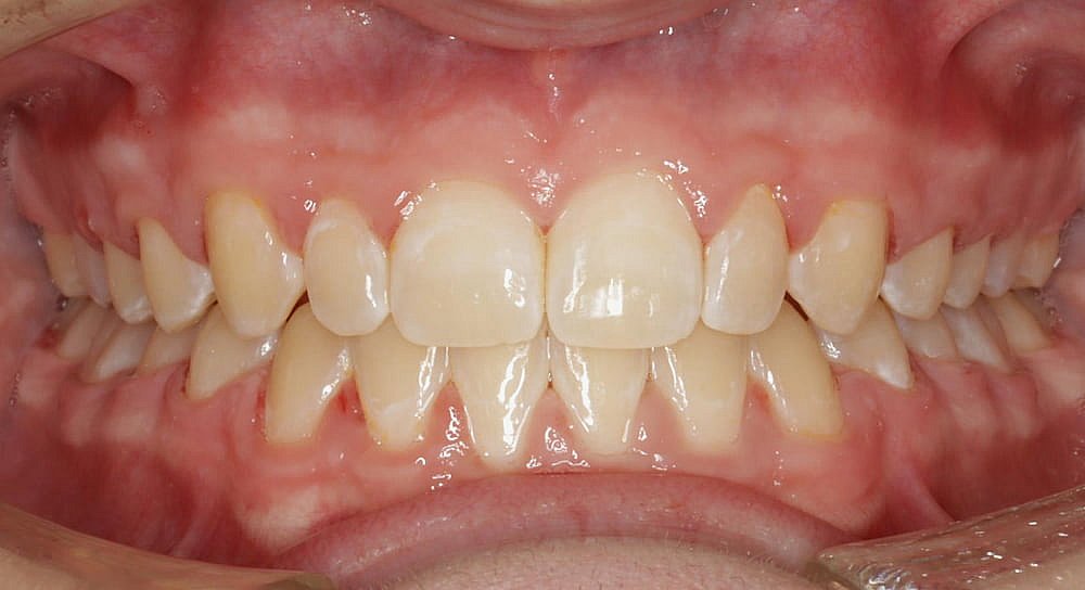 Close-up of a person's teeth showing front teeth alignment after Invisalign, with visible gums and natural tooth color variation in Greenville, SC