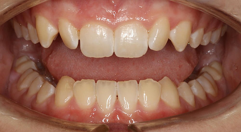 Close-up of an open mouth before Invisalign treatment, showcasing the upper and lower teeth with slight crowding and natural coloration in Greenville, SC