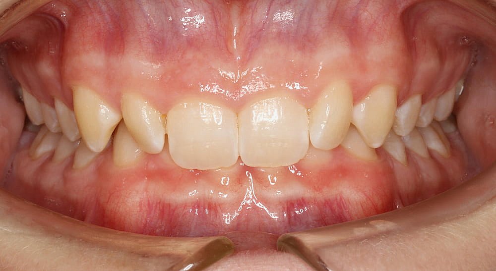 Close-up of an open mouth showing teeth and gums before Invisalign in Greenville, SC