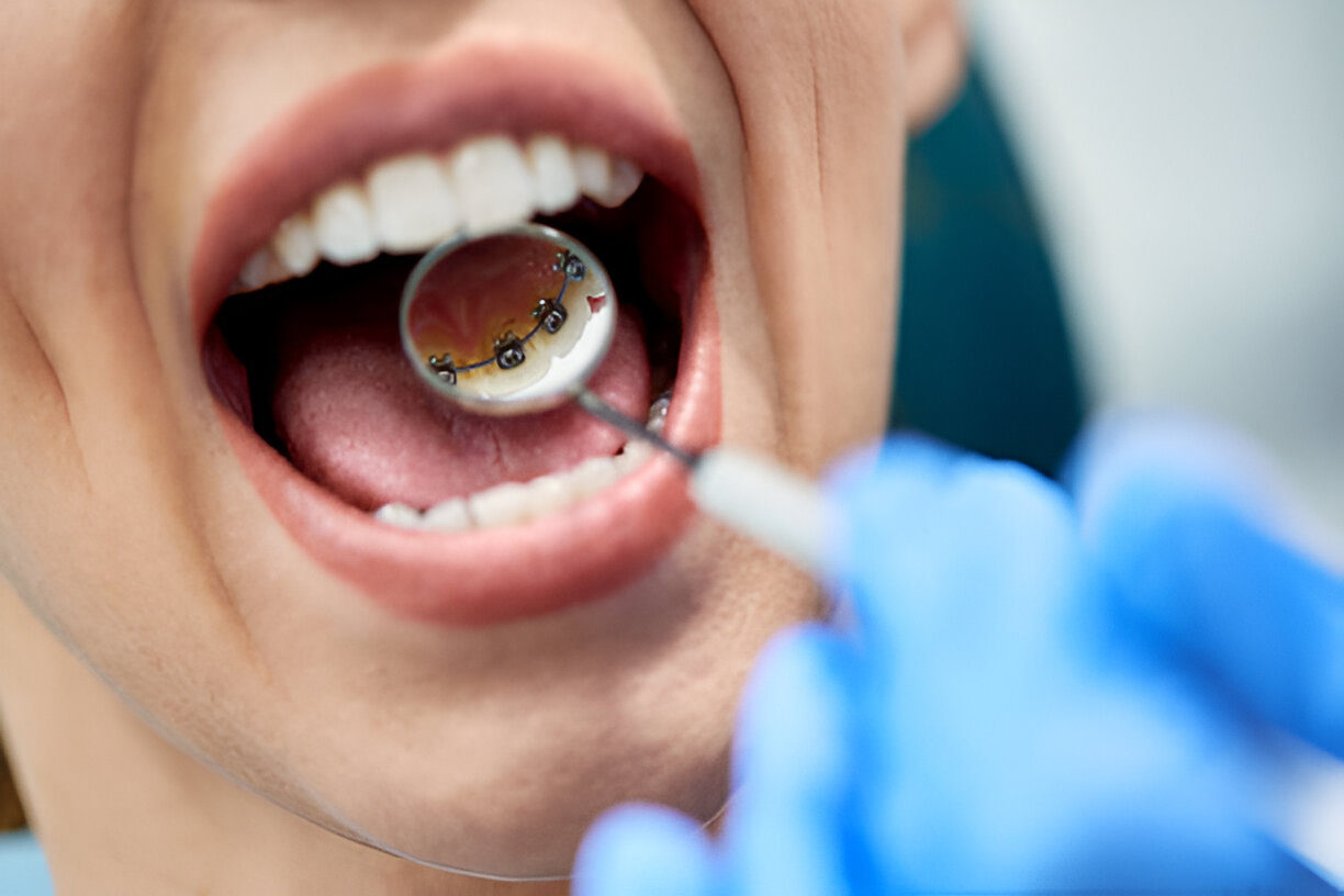 A person with lingual braces mouth open and dentist to hold a mirror to inspect her teeth at Tollison Orthodontics in Greenville, SC
