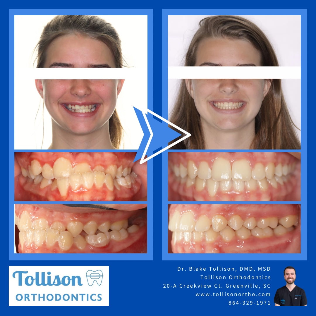 Before and after image of orthodontic treatment showing improved teeth alignment and smile. Includes contact details for Tollison Orthodontics in Greenville SC
