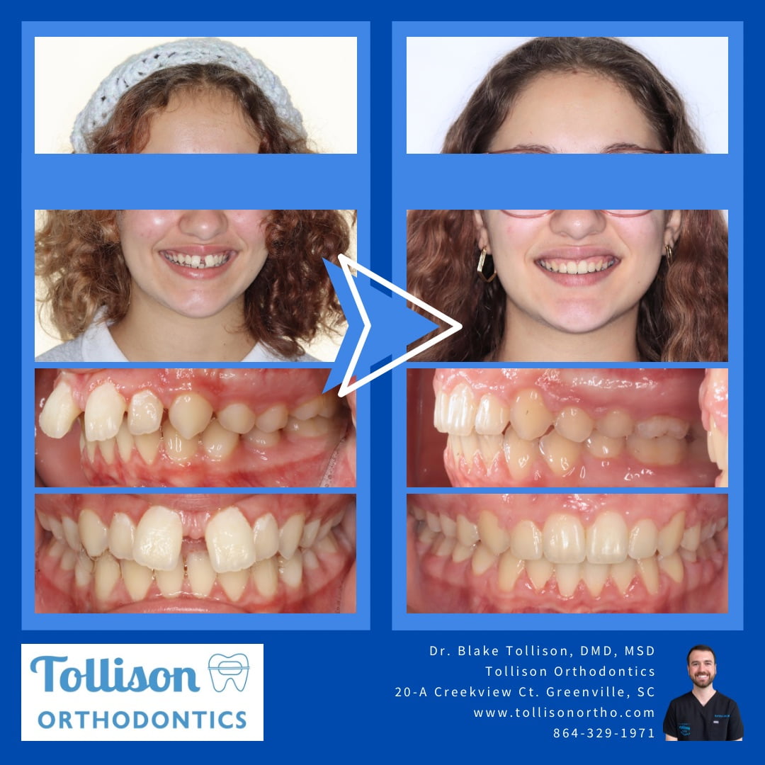 Side-by-side images of a person's teeth before and after orthodontic treatment, showing alignment improvement. Tollison Orthodontics branding and contact details at the bottom in Greenville SC