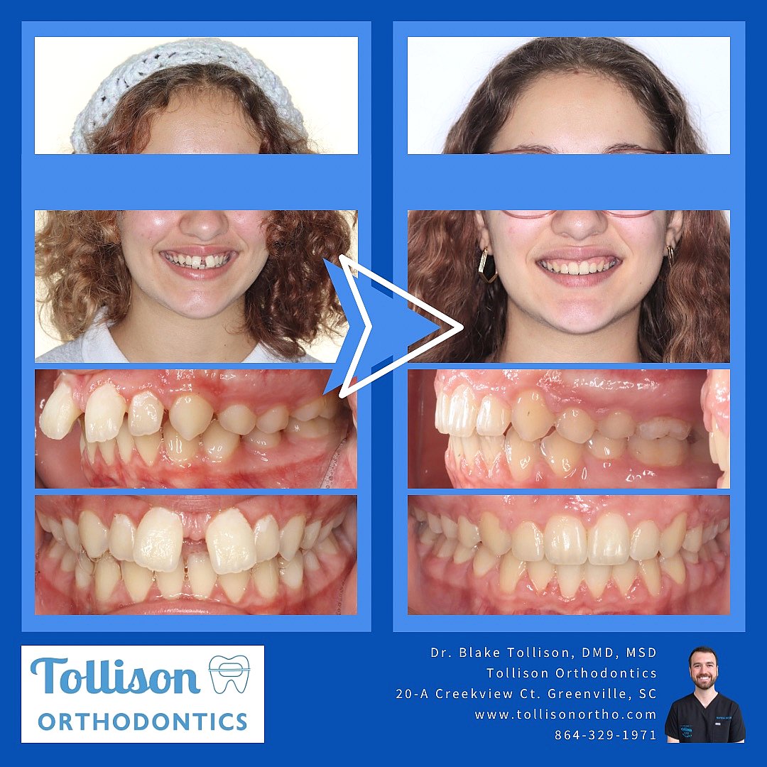 Before-and-after braces photos of a girl's improved smile and teeth after orthodontic care at Tollison Orthodontics in Greenville, SC.